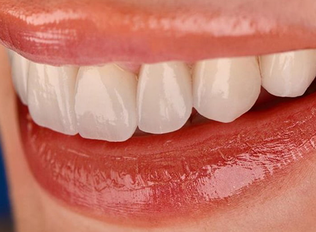 Zirkonyum Estetik Porselen