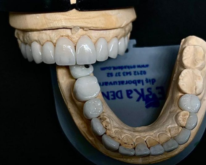 IPS Empress II Lamina